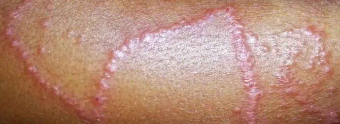 Εφιάλτης στις παραλίες: Μετά τις μωβ ήρθαν και οι γαλάζιες μέδουσες – Οι περιοχές που είναι στο «κόκκινο»