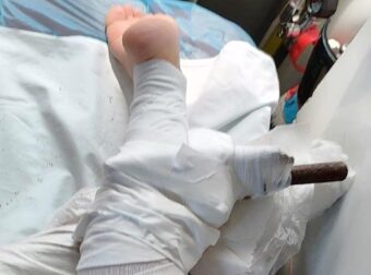 Δεύτερο περιστατικό μέσα σε λίγες εβδομάδες: Ομπρέλα καρφώθηκε στο πόδι 26χρονης – Μεταφέρθηκε στο νοσοκομείο