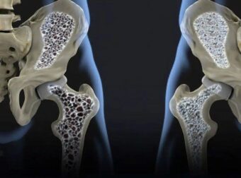 Ήπιατε πολύ; Τα κόκαλα σας θα μπορούσαν να έχουν πρόβλημα – Ιδού 3 κρυμμένοι ένοχοι που κλέβουν το Ασβέστιο σας