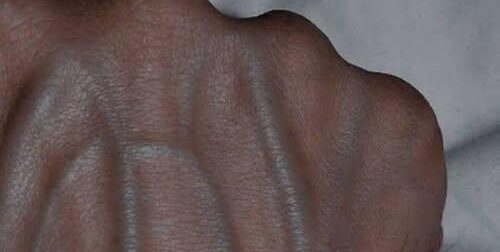 5 προβλήματα υγείας που μπορούν να προκαλέσουν ορατές φλέβες