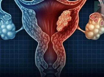 3 προσωπικές συνήθειες των συζύγων που μπορεί να αυξńσουν τον κίνδυνο καρκίνου του τραχήλου στις γυναίκες