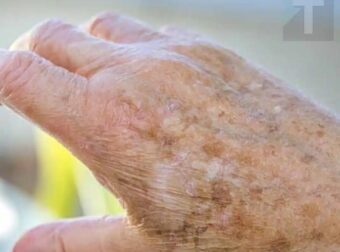 Γιατί εμφανίζονται κηλίδες στα χέρια μας και πώς μπορούμε να τις εξαλείψουμε;