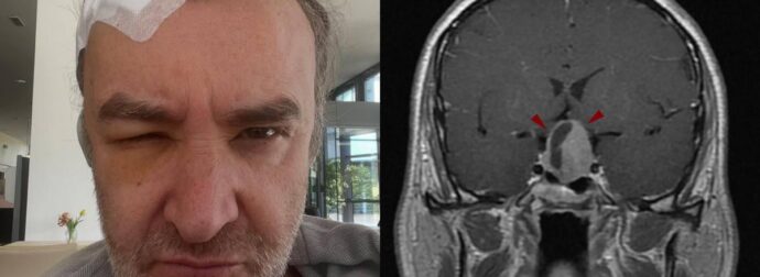 Νίκος Ορφανός: Τι είναι το κρανιοφαρυγγίωμα που αντιμετώπισε – Ποιοι επηρεάζονται, οι κυριότερες θεραπείες