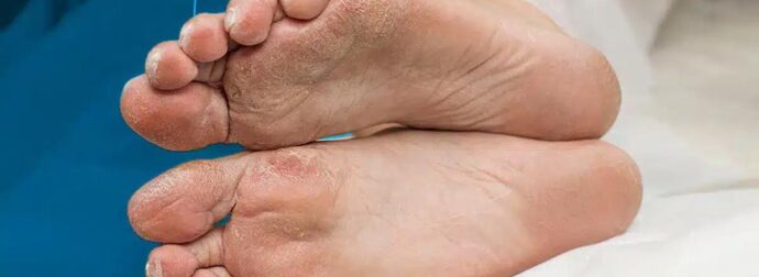 Προειδοποίηση: Αν το έχετε αυτό στα πόδια σας, μπορεί να είναι σημάδι