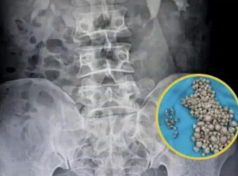 Οι γιατροί σοκαρίστηκαν αφού βρήκαν 300 πέτρες στα νεφρά σε νέα γυναίκα