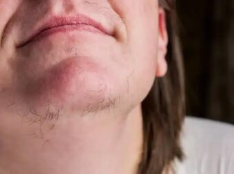 Αν είστε γυναίκα με γένια στο σαγόνι να τι σημαίνει για εσάς – Αυτές οι τρίχες στο…