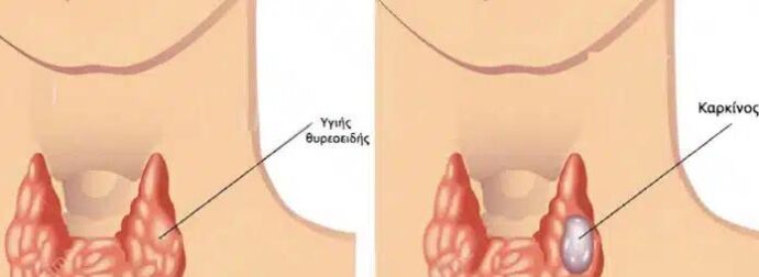 Οι περιπτώσεις καρκίνου του θυρεοειδούς αuξάνονται ραγδαία. Οι γιατροί σας συμβουλεύουν να τρώτε λιγότερο από αυτές τις τροφές