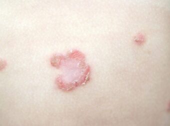 Απλές συμβουλές για να αποφύγετε την μυκητίαση του δέρματος