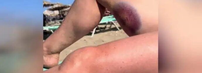 Κρήτη: Χελώνα έκανε διπλή επίθεση σε τουρίστρια δαγκώνοντάς την στο πόδι – Δείτε βίντεο