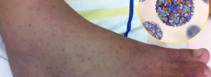 «Καμπανάκι» επιστημόνων για τον ιό τσικουνγκούνια – Φόβοι για νέα πανδημία