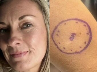 «Είχα μια ελιά τέσσερα χρόνια που εξελίχθηκε σε καρκίνο» – Πώς ήταν ο σπίλος της 46χρονης