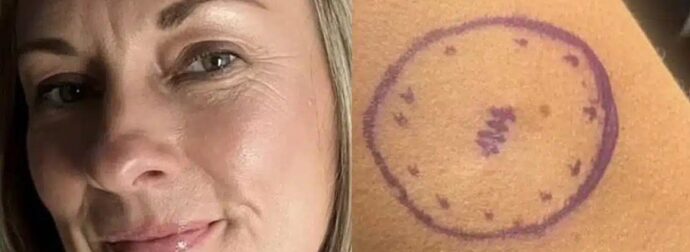 «Είχα μια ελιά τέσσερα χρόνια που εξελίχθηκε σε καρκίνο» – Πώς ήταν ο σπίλος της 46χρονης