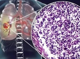 Ο αόρατος Kivδuvoς – Τι κοινό υλικό κουζίνας συνδέεται με Kαpκivo πνεύμονα – Πpoσoxn στο σπίτι σας