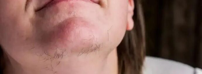 Αν είστε γυναίκα με γένια στο σαγόνι να τι σημαίνει για εσάς – Αυτές οι τρίχες στο…