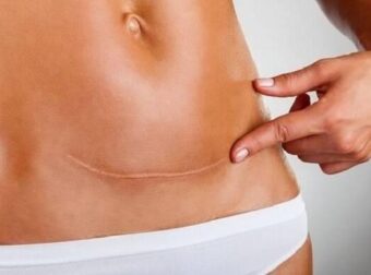 3 πράγματα που όλοι μας πρέπει να ξέρουμε για τις γυναίκες που έχουν κάνει καισαρική